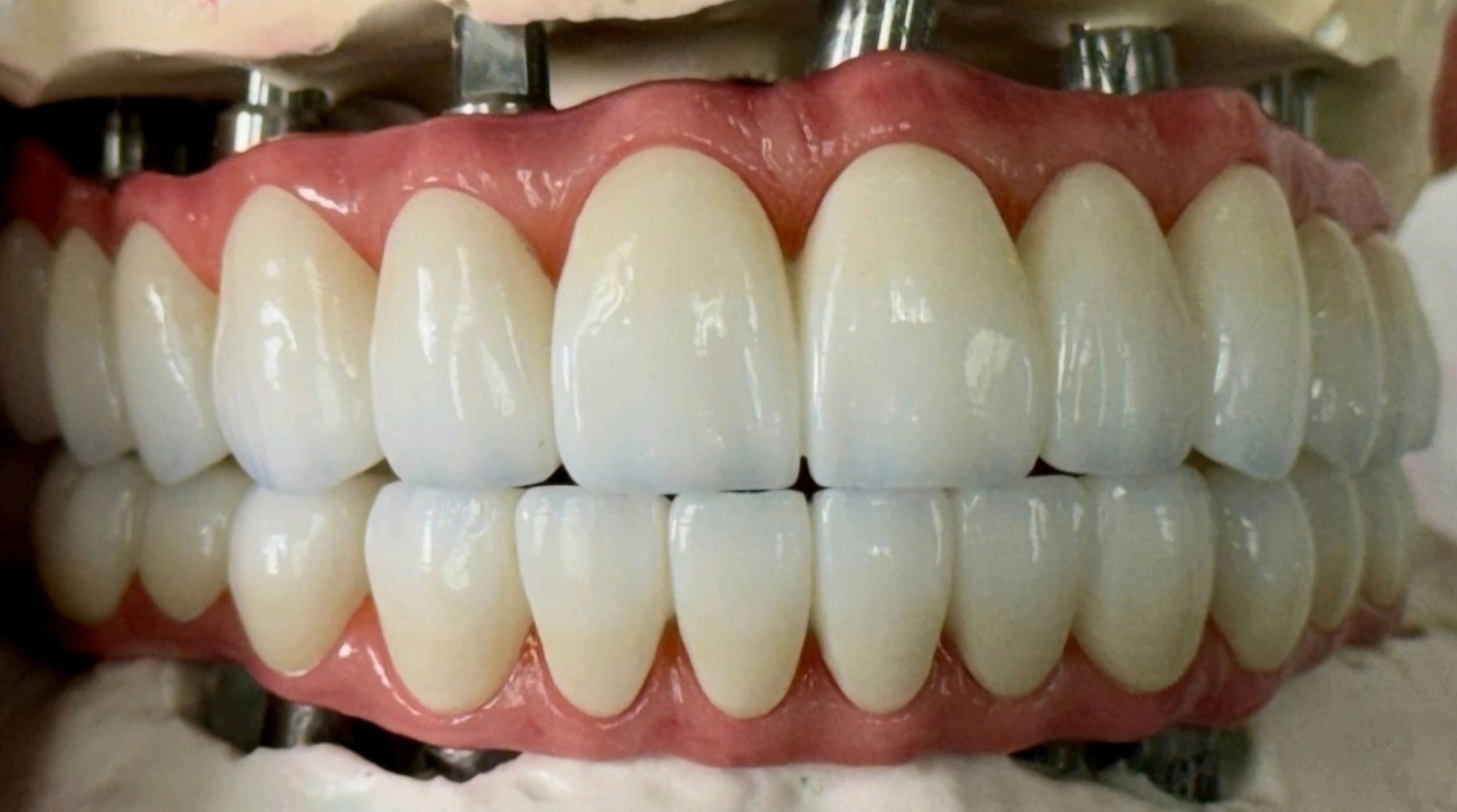 Dental prosthetic restoration work 3