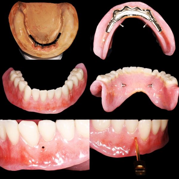 Removable implant retained prosthesis
